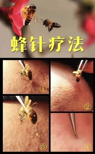 蜂疗,从古代巫术到现代精准医学的奇迹之路 蜂疗,从古代巫术到现代精准医学的奇迹之路