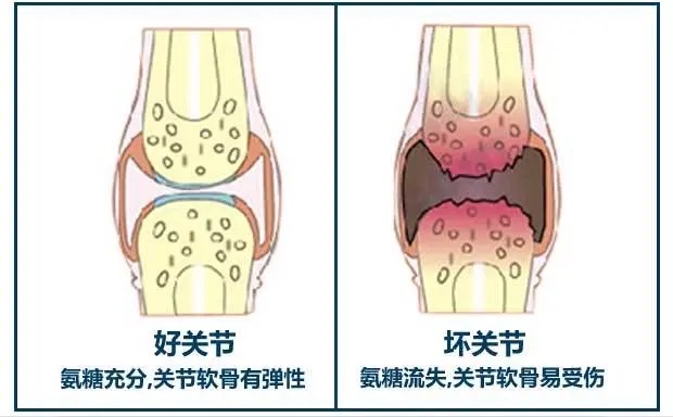 聚焦中老年人骨关节疾病:探寻氨糖补充的奥秘 聚焦中老年人骨关节疾病:探寻氨糖补充的奥秘