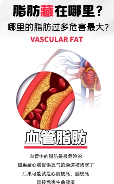 警惕!“血管杀手”——血栓偏爱这些人 警惕!“血管杀手”——血栓偏爱这些人