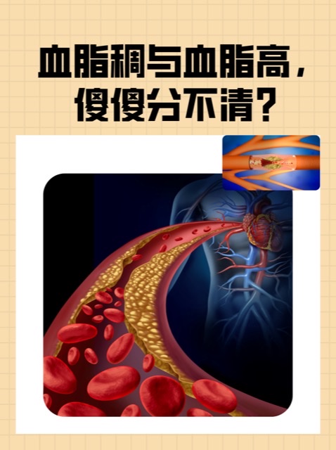 警惕!“血管杀手”——血栓偏爱这些人 警惕!“血管杀手”——血栓偏爱这些人