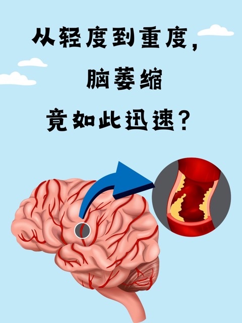 没有这个习惯的人更容易脑萎缩!送你健脑小秘诀,远离痴呆身体棒 没有这个习惯的人更容易脑萎缩!送你健脑小秘诀,远离痴呆身体棒