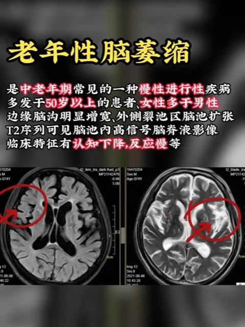 没有这个习惯的人更容易脑萎缩!送你健脑小秘诀,远离痴呆身体棒 没有这个习惯的人更容易脑萎缩!送你健脑小秘诀,远离痴呆身体棒