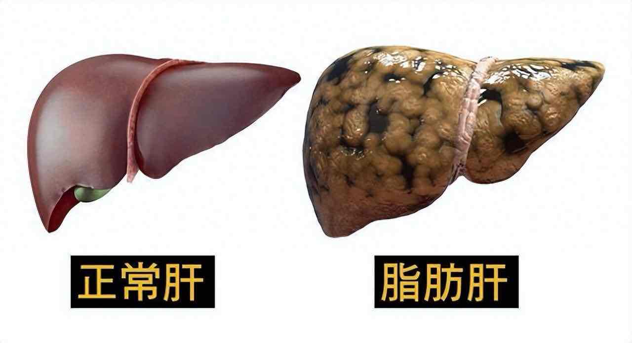 老年人脂肪肝患者注意:少喝酒只是基础,多吃这几类食物更护肝 老年人脂肪肝患者注意:少喝酒只是基础,多吃这几类食物更护肝