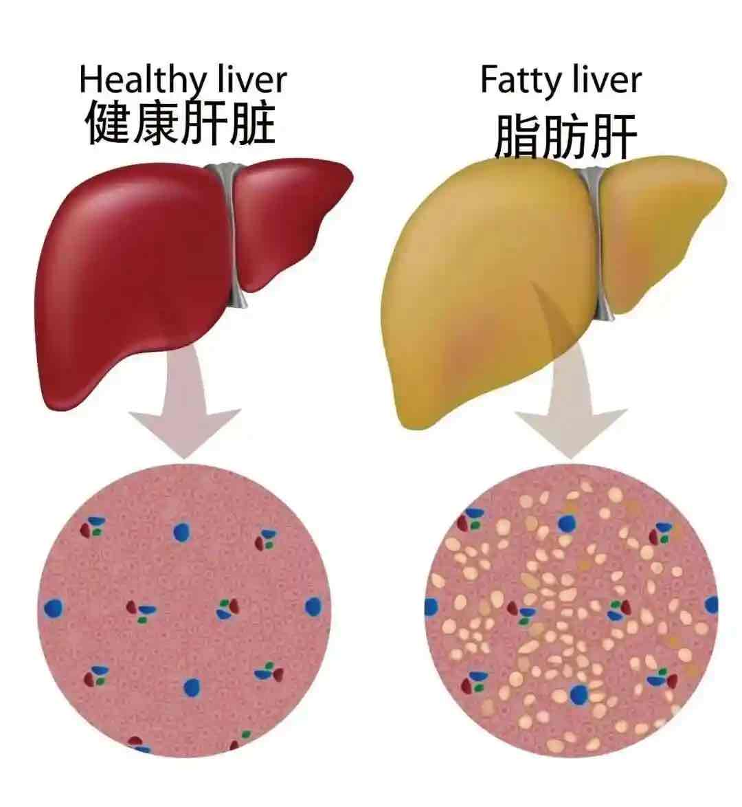 老年人脂肪肝患者注意:少喝酒只是基础,多吃这几类食物更护肝 老年人脂肪肝患者注意:少喝酒只是基础,多吃这几类食物更护肝