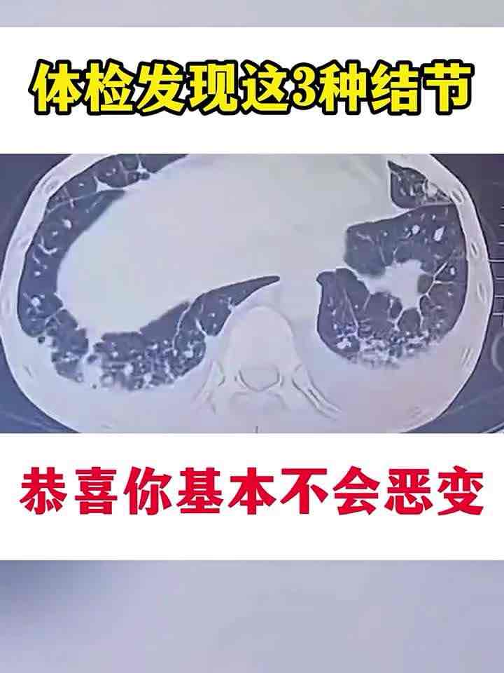 体检查出结节怎么办?避开误区,这样应对最科学 体检查出结节怎么办?避开误区,这样应对最科学
