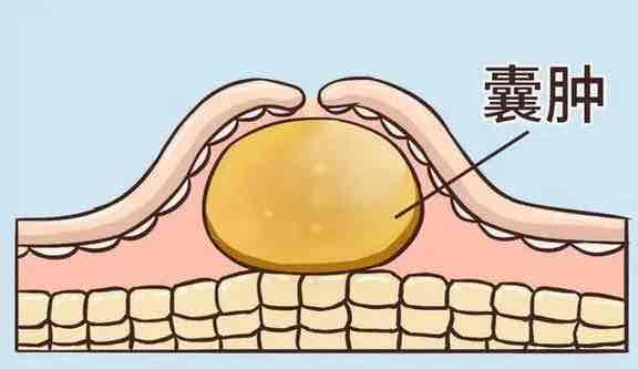 体检查出结节怎么办?避开误区,这样应对最科学 体检查出结节怎么办?避开误区,这样应对最科学