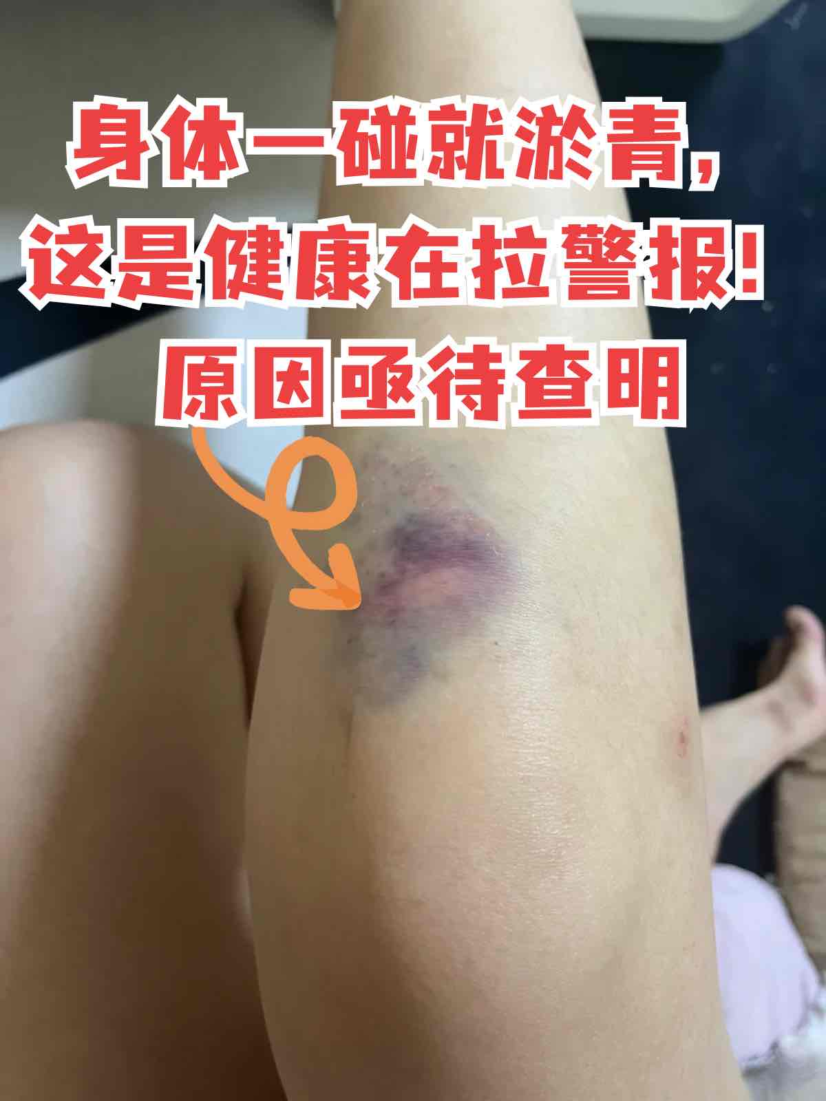 老年人身上莫名淤青?别忽视!可能是身体发出的“健康警报” 老年人身上莫名淤青?别忽视!可能是身体发出的“健康警报”
