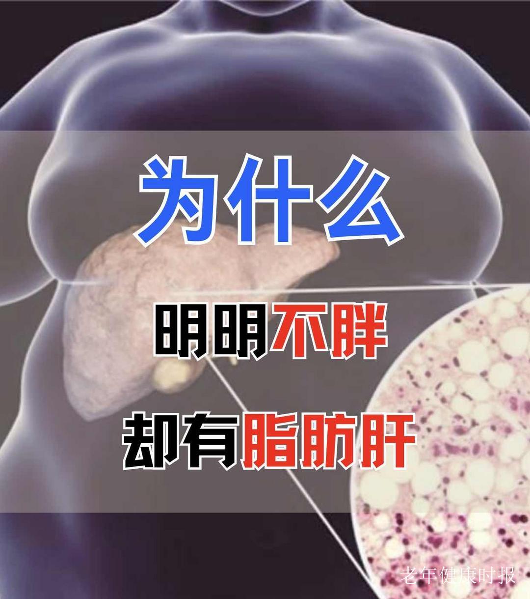 脂肪肝不是“无关痛痒”?医生实话实说:它是可逆的“健康预警” 脂肪肝不是“无关痛痒”?医生实话实说:它是可逆的“健康预警”
