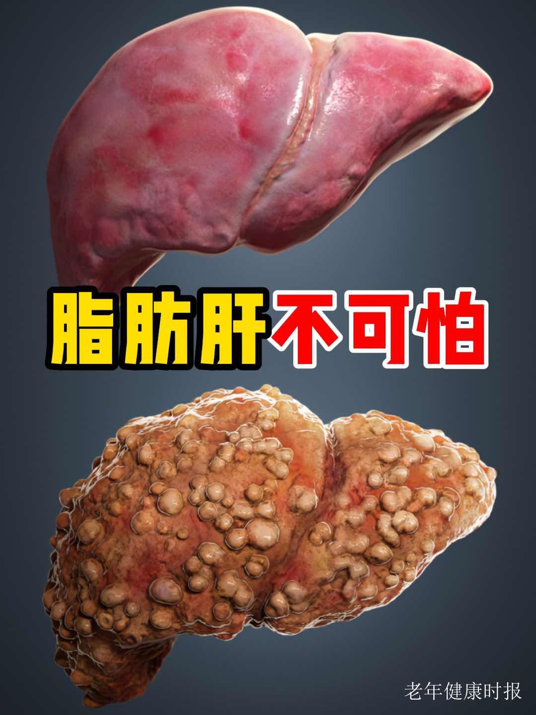 脂肪肝不是“无关痛痒”?医生实话实说:它是可逆的“健康预警” 脂肪肝不是“无关痛痒”?医生实话实说:它是可逆的“健康预警”