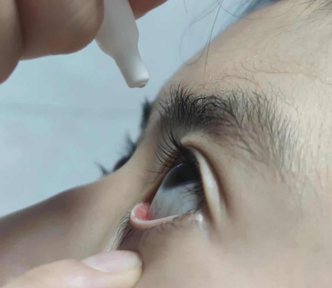 眼药水别直接滴眼球!中老年正确用法,护眼不伤人 眼药水别直接滴眼球!中老年正确用法,护眼不伤人