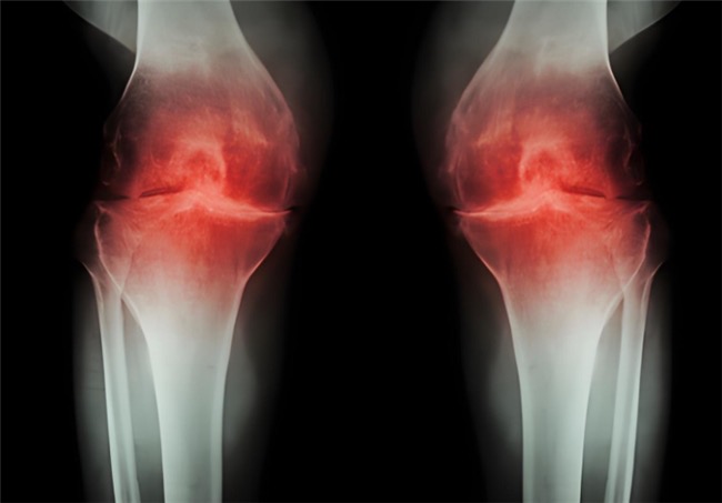 盐酸和硫酸氨基葡萄糖的作用与功效对比,应对骨关节炎如何抉择? 盐酸和硫酸氨基葡萄糖的作用与功效对比,应对骨关节炎如何抉择?