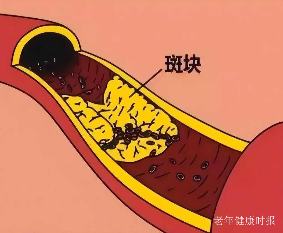 查出血管斑块别慌!做好这几点,斑块竟能慢慢缩小甚至消失 查出血管斑块别慌!做好这几点,斑块竟能慢慢缩小甚至消失